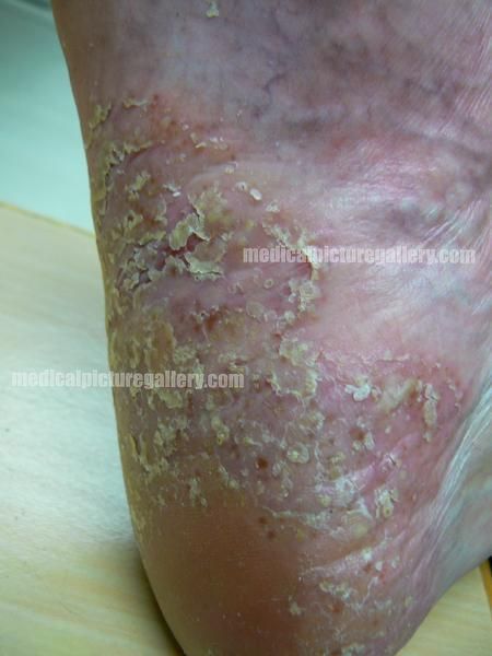 Psoriasis pustulosa