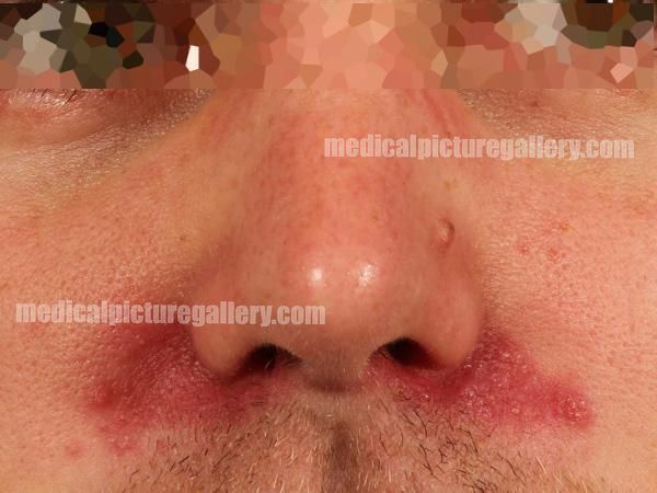 Perioral/-nasal/-orbital dermatitis