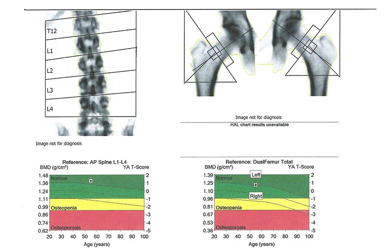 How Much Estrogen Do Your Bones Need? The Science Behind E2 and Bone Density