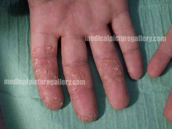 Psoriasis guttata