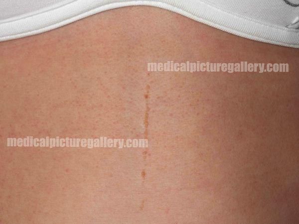 Linear epidermal nevi