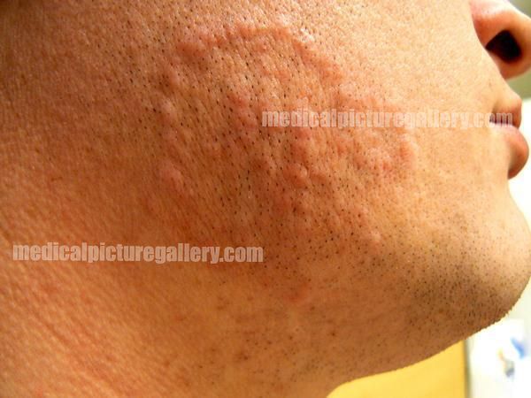 Tinea corporis